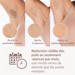 Dispositivo de depilación IPL Philips BRI949/00 - Imagen 9